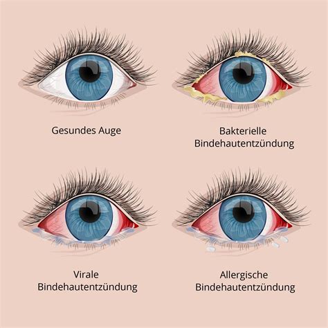 Illustration verschiedener Symptome einer Bindehautentzündung: Rötung, Sekret, Schwellung