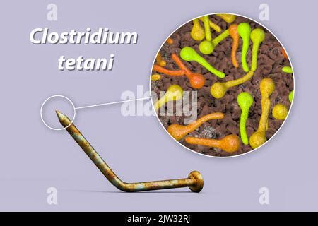 Illustration, die die Übertragung von Tetanus von der Mutter auf das Neugeborene unter unhygienischen Bedingungen darstellt