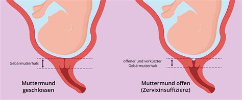 Grafik, die den Gebärmutterhals und den Muttermund zeigt