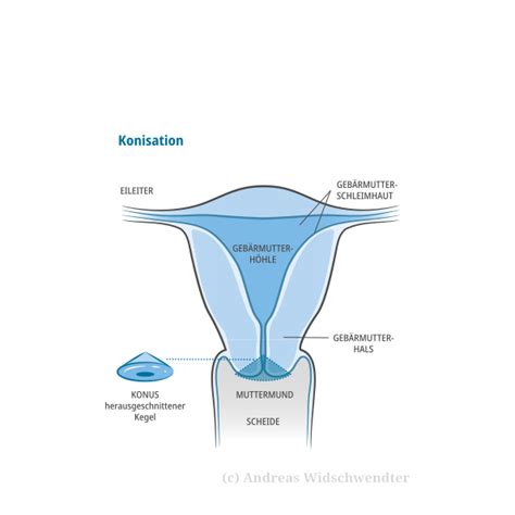 Darstellung einer Konisation