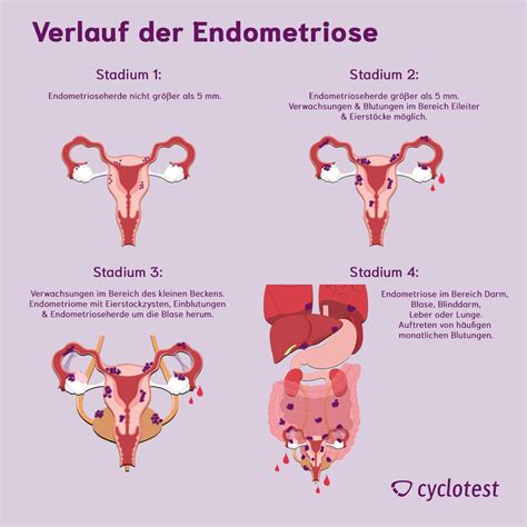 Schema der Endometriose: Darstellung von typischen Lokalisationen der Endometrioseherde im Bauchraum.
