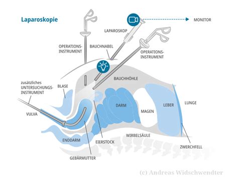 Illustration einer Laparoskopie zur Diagnose und Behandlung von Endometriose.