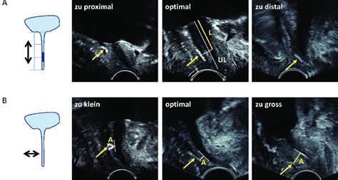 Abbildung 1: Pelvic-Floor-Sonografie zur Beurteilung der Urethra und der Bandlage.