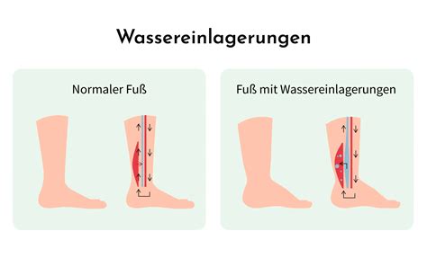Illustration von Wassereinlagerungen in den Beinen einer Schwangeren