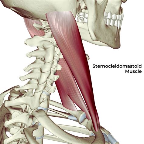 Darstellung eines infantilen Schiefhalses (M. sternocleidomastoideus)
