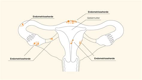 Schema der Gebärmutter mit Markierungen, die die Alvarez-Wellen und später die Braxton-Hicks-Kontraktionen darstellen.