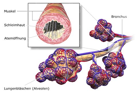 Illustration des Gasaustauschs in gesunden Lungenbläschen und bei Atemnotsyndrom