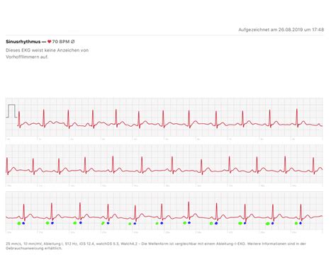 Beispiel eines EKGs mit Sinusarrhythmie und Sinuspause