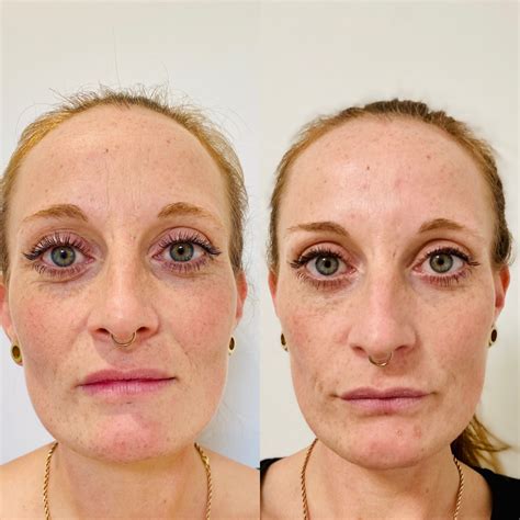 Vergleichsbilder (Vorher/Nachher) von Behandlungen mit Hyaluronsäure oder Botulinumtoxin