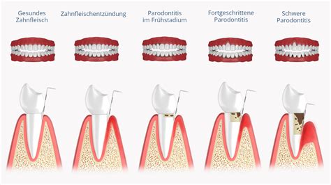 Schema, das die verschiedenen Stadien von Gingivitis und Parodontitis bei Katzen zeigt