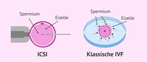 Schema der künstlichen Befruchtung (IVF und ICSI)