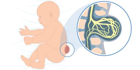 Bild eines Neugeborenen nach einer erfolgreichen Operation zur Korrektur von Spina Bifida