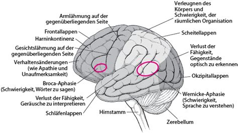Schema des Gehirns eines Frühchens mit Hervorhebung der Keimzellmatrix