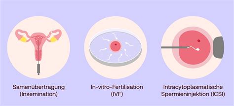Schema der künstlichen Befruchtung (IVF/ICSI)