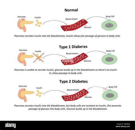 Schema der unterschiedlichen Typen von Diabetes mellitus
