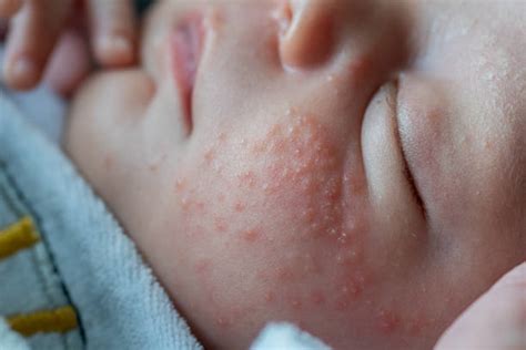 Nahaufnahme von Baby-Akne auf den Wangen