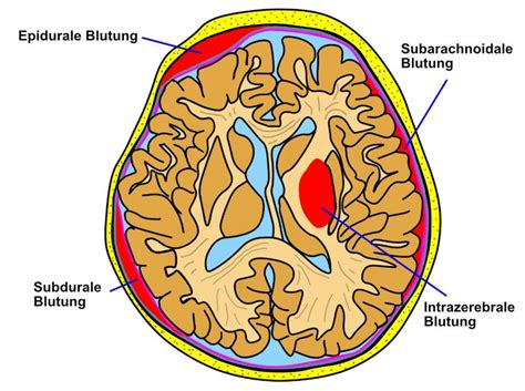 Illustration verschiedener Arten von intrakraniellen Blutungen (IVH, ICB, SAB, SDH, EDH)