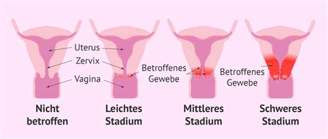 Illustration des Gebärmutterhalses mit Hervorhebung der betroffenen Bereiche bei Zervixkarzinom