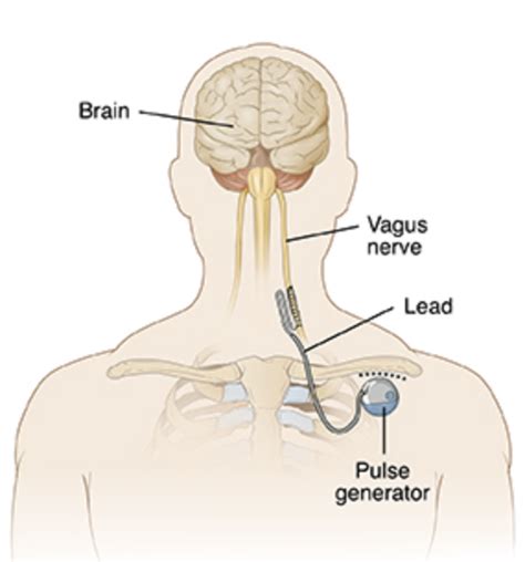 Schema der Vagusnerv-Stimulation zur Rehabilitation.