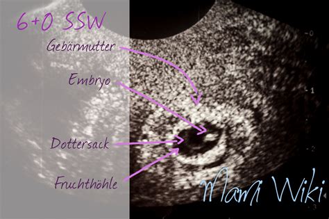Ultraschallbild: Embryo in der 6. Schwangerschaftswoche mit erkennbaren Ansätzen der Gliedmaßen und schlagendem Herzen