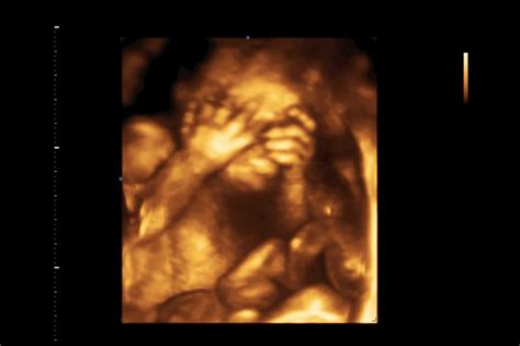 3D-Ultraschallbild: Fötus in der 9. Schwangerschaftswoche mit erkennbaren Fingern und Gesichtszügen