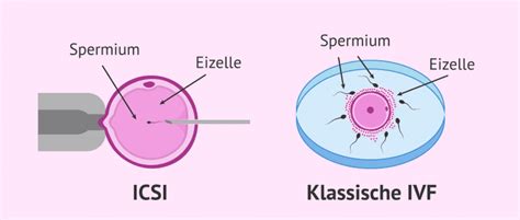Vergleichsgrafik, die den Unterschied zwischen IVF (Spermien umgeben die Eizelle) und ICSI (ein Spermium wird direkt in die Eizelle injiziert) darstellt.