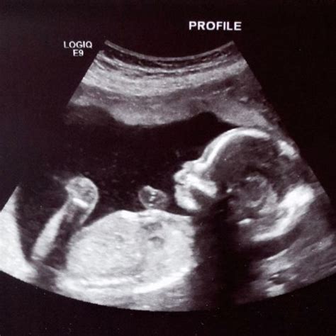 Beispiel eines detaillierten Ultraschallbildes eines Babys in der 19. SSW