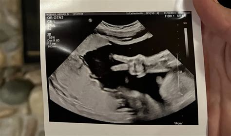 Ultraschallbild, das eine Gastroschisis bei einem Fötus zeigt