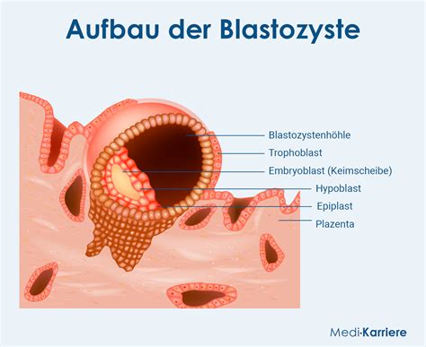 Darstellung einer Blastozyste, die sich in die Gebärmutterschleimhaut einnistet