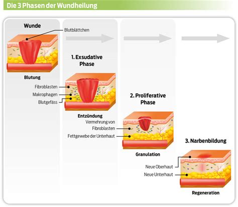 Vergleich der Narbenoptik in verschiedenen Heilungsphasen