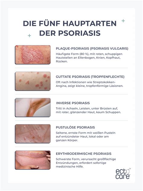 Grafik mit den verschiedenen Formen der Schuppenflechte (Psoriasis) und deren typischen Symptomen