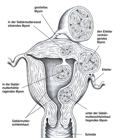 Schema der Gebärmutter mit verschiedenen Myom-Lokalisationen