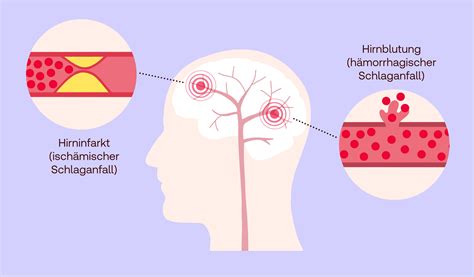 Illustration, die die typischen Symptome des HELLP-Syndroms visuell darstellt