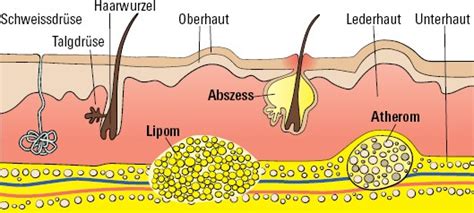 Darstellung eines Atheroms (Talgzyste)