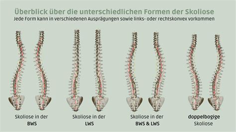 Illustration, die verschiedene Arten von Skoliose-Krümmungen zeigt (z.B. C-Form, S-Form)