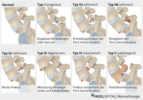 Schema der Lendenwirbelsäule, das eine Spondylolyse und Spondylolisthese veranschaulicht