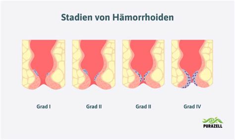 Schema der vier Stadien von Hämorrhoiden
