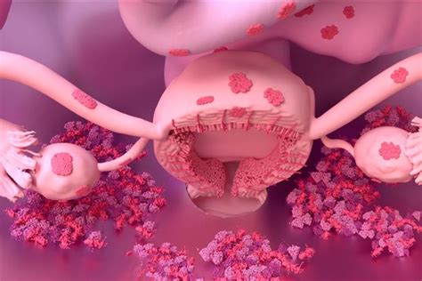 Illustration von Endometrioseherden