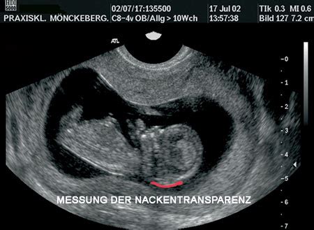 Ultraschallbild eines Fötus mit Markierung der Nackenfalte