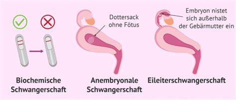 Illustration, die die drei Behandlungsmöglichkeiten bei einer Fehlgeburt darstellt