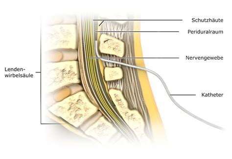 Illustration einer Periduralanästhesie (PDA) zur Schmerztherapie während der Geburt