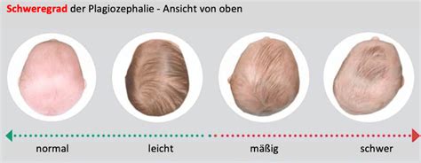 Schema einer lagebedingten Kopfdeformität mit Asymmetrie der Ohren und Stirn.