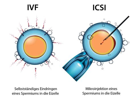 Grafik, die die Schritte der IVF und ICSI veranschaulicht
