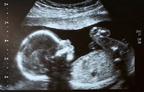 Ultraschallbild eines sprungreifen Follikels