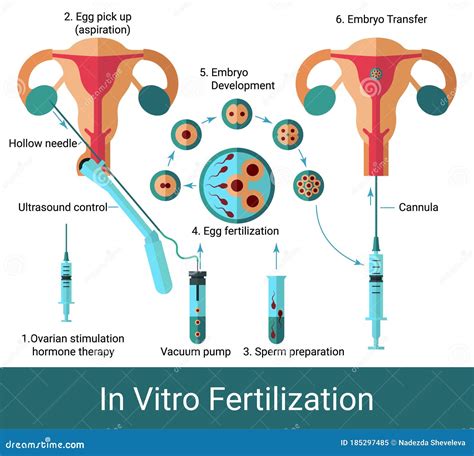 Schema einer In-vitro-Fertilisation (IVF)