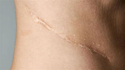 Nahaufnahme einer gut verheilten Kaiserschnittnarbe