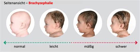 Illustration, die die verschiedenen Arten von Schädeldeformitäten (Plagiozephalie, Brachyzephalie, Dolichozephalie) darstellt