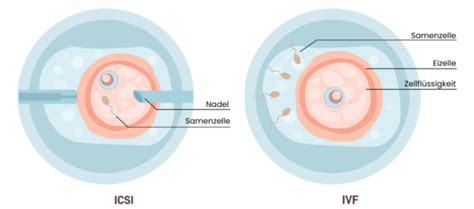 Schema der In-vitro-Fertilisation (IVF) und ICSI.