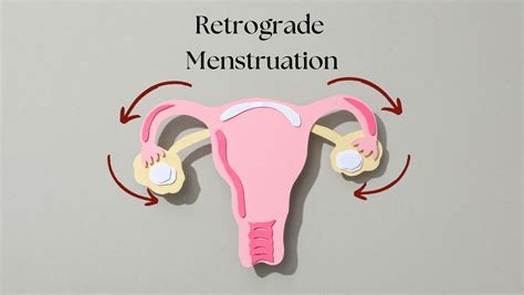 Schema zur Entstehung von Endometriose-Herden durch retrograde Menstruation