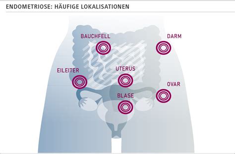 Darstellung von Endometriose-Herden an verschiedenen Organen im Bauchraum